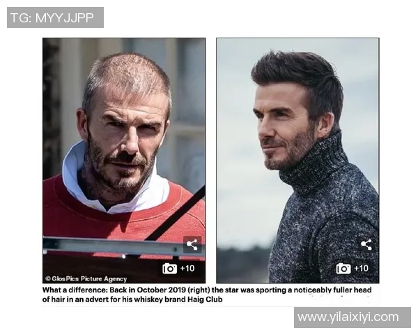 秃顶足球球星如何应对发量困扰与职业生涯的挑战